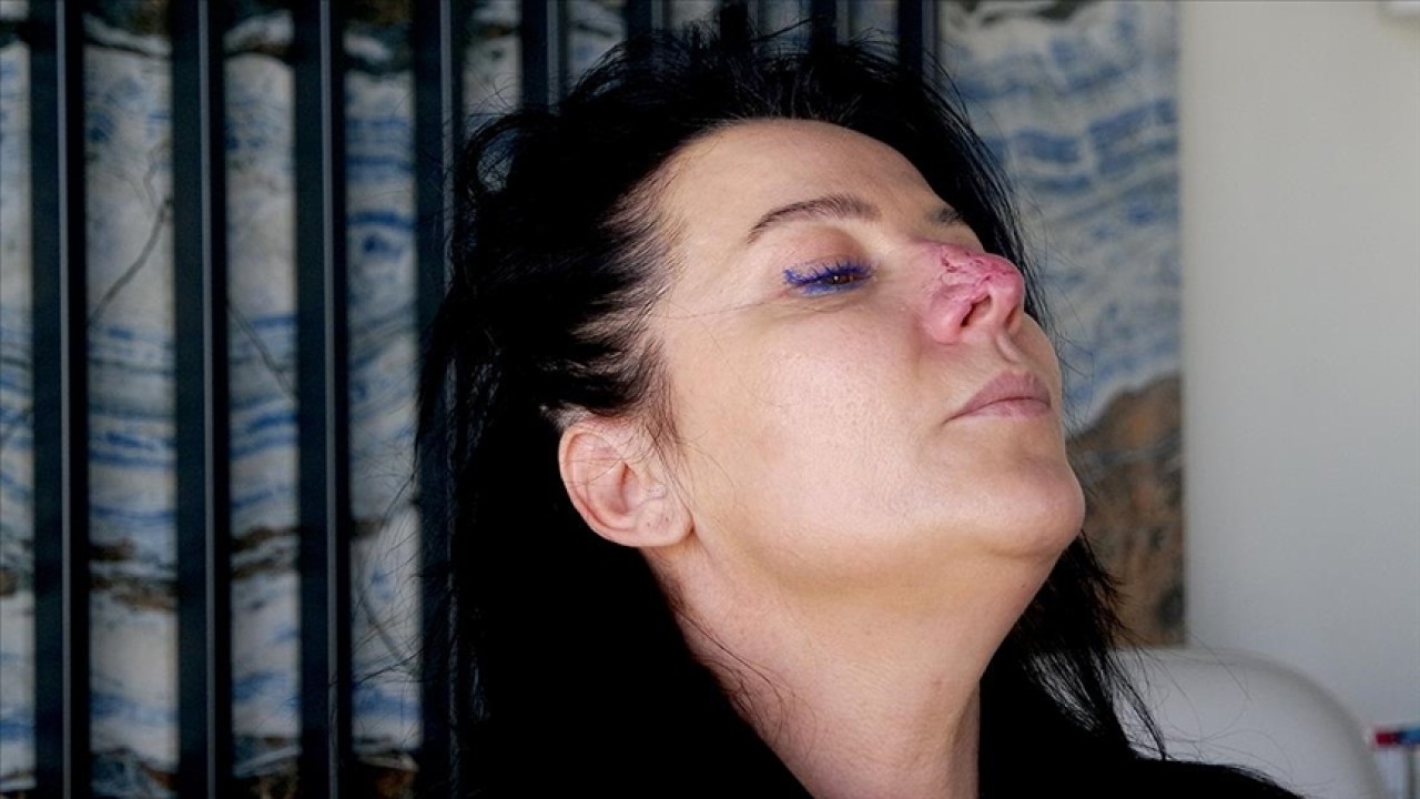 Arkadaşının köpeği tarafından burnu parçalanan kadının hukuk mücadelesi sürüyor